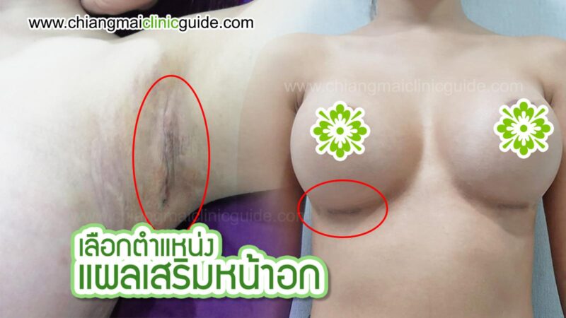 แผลหลังเสริมหน้าอก ใต้ราวนม รักแร้ ปานนม ผลดีผลเสีย ต่างกันอย่างไร เคสแก้เลือกแผลแบบไหน