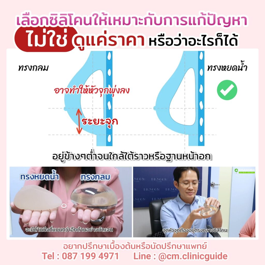 ซิลิโคนเสริมหน้าอกระหว่างทรงกลมกับทรงหยดน้ำต่างกันอย่างไร