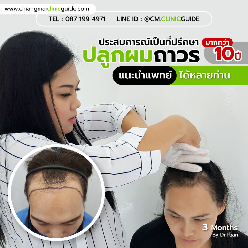 ปลูกผมถาวร ผู้หญิง เชียงใหม่ โดยหมอป่าน Hair Transplant Chiang Mai