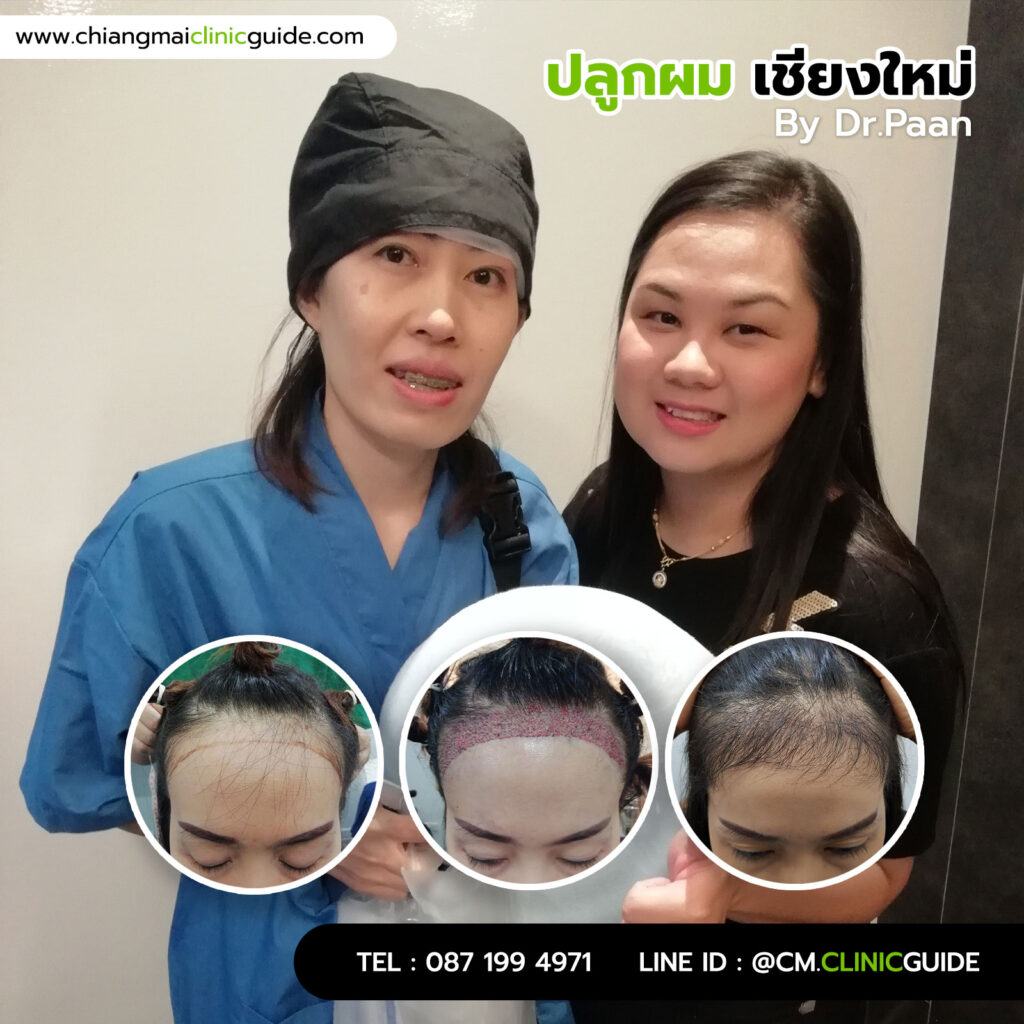 ปลูกผมผู้หญิง เชียงใหม่ โดยหมอป่าน