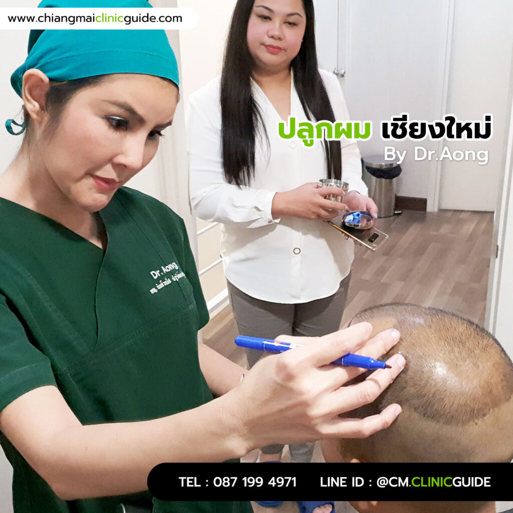 ปลูกผมเชียงใหม่ โดยหมออ๋อง