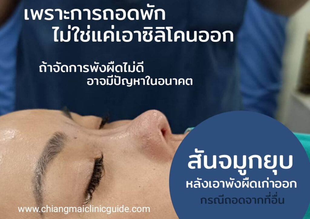 ถอดซิลิโคนจมูก