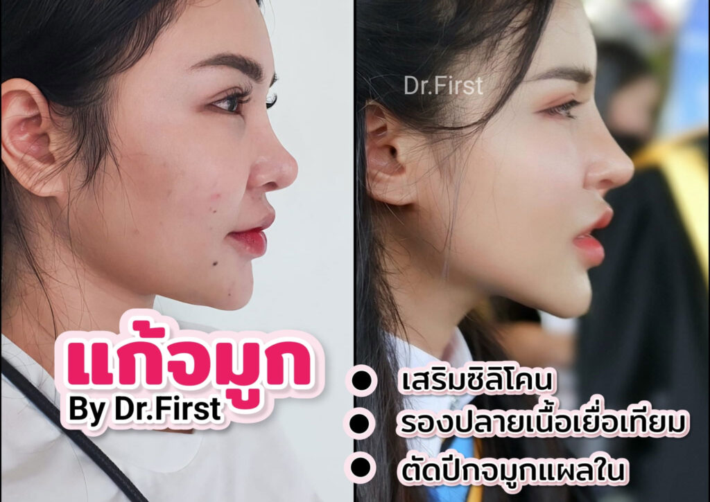 แก้ไขจมูกและตัดปีกจมูก