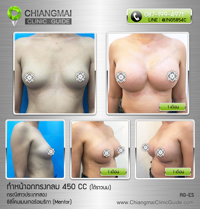 รีวิวเสริมหน้าอกเชียงใหม่ สาวประเภทสอง ซิลิโคนเมนเทอร์ (Mentor) 450cc แผลใต้ราวนม