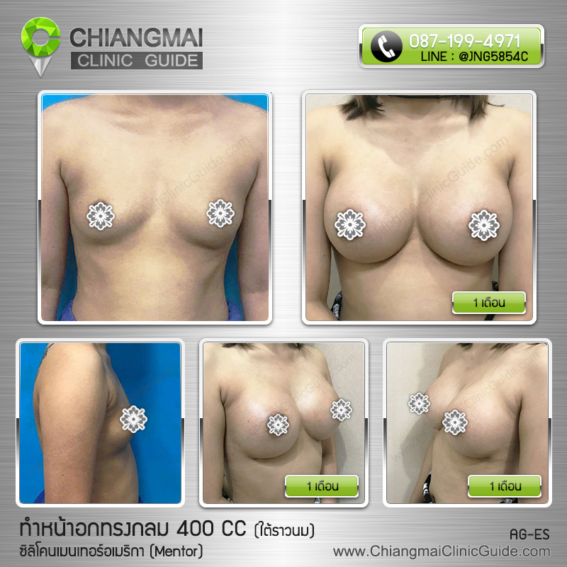 รีวิวเสริมหน้าอกเชียงใหม่ ซิลิโคนเมนเทอร์ (Mentor) 400cc แผลใต้ราวนม
