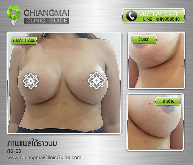 รีวิวเสริมหน้าอกเชียงใหม่ แผลใต้ราวนม