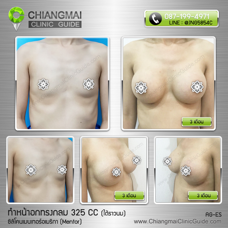 รีวิวเสริมหน้าอกเชียงใหม่ ซิลิโคนเมนเทอร์ (Mentor) 325cc แผลใต้ราวนม