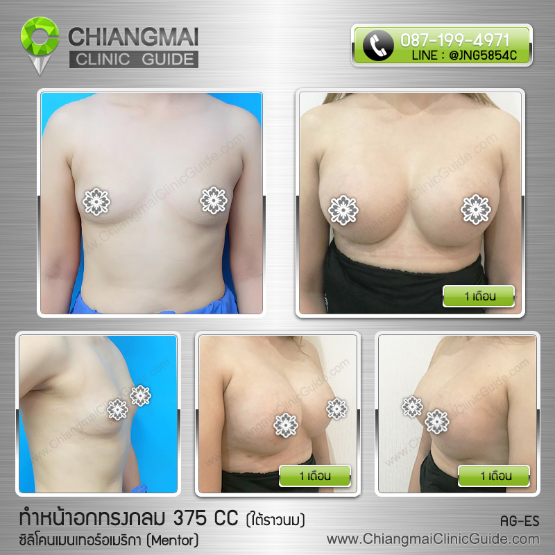 รีวิวเสริมหน้าอก เชียงใหม่ ซิลิโคนเมนเทอร์ (Mentor) 375cc แผลใต้ราวนม