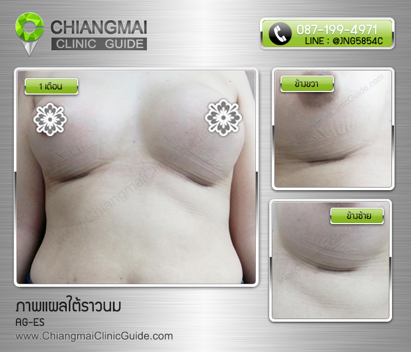รีวิวเสริมหน้าอกเชียงใหม่ แผลใต้ราวนม