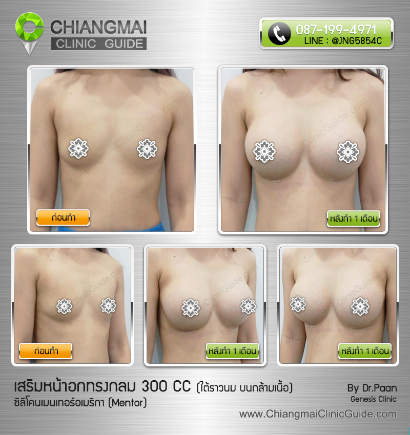 รีวิวเสริมหน้าอกเชียงใหม่ ซิลิโคนเมนเทอร์ (Mentor) 300cc แผลใต้ราวนม วางซิลิโคนใต้กล้ามเนื้อ