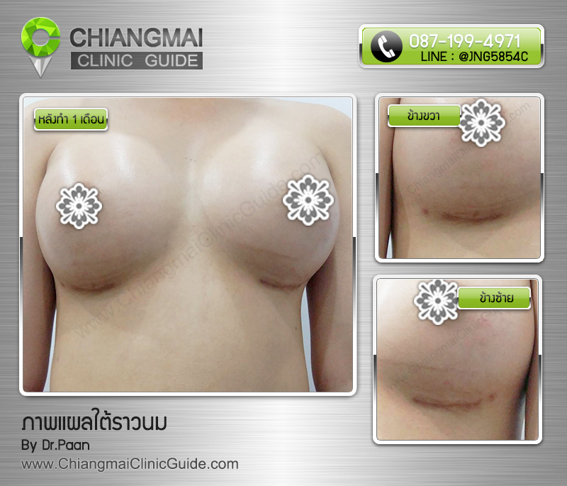รีวิวเสริมหน้าอกเชียงใหม่ แผลใต้ราวนม