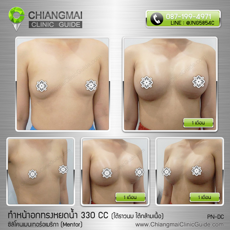 รีวิวเสริมหน้าอกเชียงใหม่ ซิลิโคนเมนเทอร์ (Mentor) ทรงหยดน้ำ 330cc แผลใต้ราวนม วางซิลิโคนใต้กล้ามเนื้อ