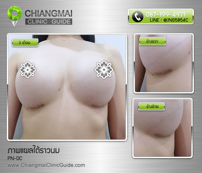 รีวิวเสริมหน้าอกเชียงใหม่ แผลใต้ราวนม