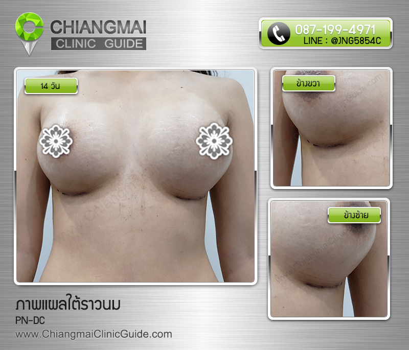 รีวิวเสริมหน้าอกเชียงใหม่ แผลใต้ราวนม