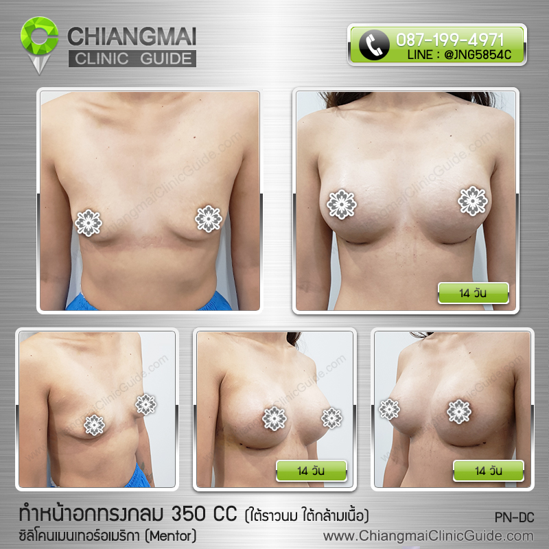 รีวิวเสริมหน้าอกเชียงใหม่ ซิลิโคนเมนเทอร์ (Mentor) 350cc แผลใต้ราวนม วางซิลิโคนใต้กล้ามเนื้อ