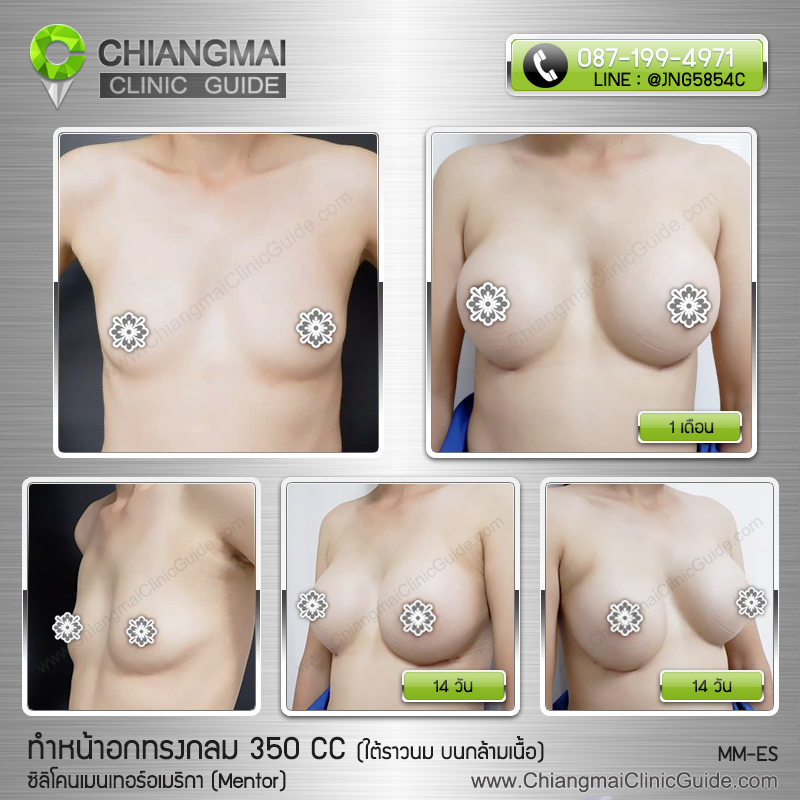 รีวิวเสริมหน้าอกเชียงใหม่ ซิลิโคนเมนเทอร์ (Mentor) 350cc แผลใต้ราวนม วางซิลิโคนบนกล้ามเนื้อ