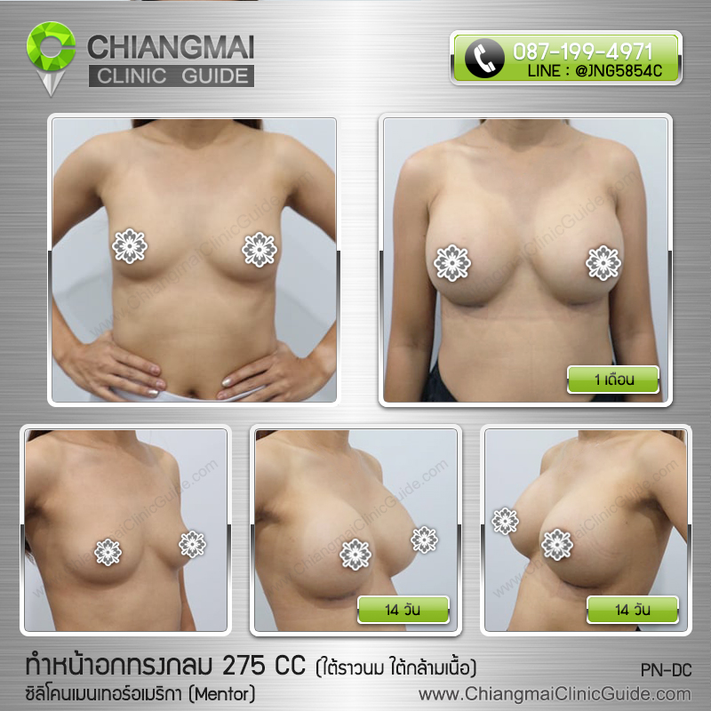 รีวิวเสริมหน้าอกเชียงใหม่ ซิลิโคนเมนเทอร์ (Mentor) 275cc แผลใต้ราวนม วางซิลิโคนใต้กล้ามเนื้อ