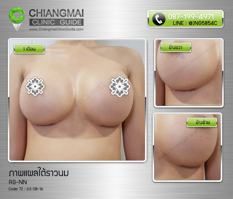 รีวิวเสริมหน้าอกเชียงใหม่ แผลใต้ราวนม