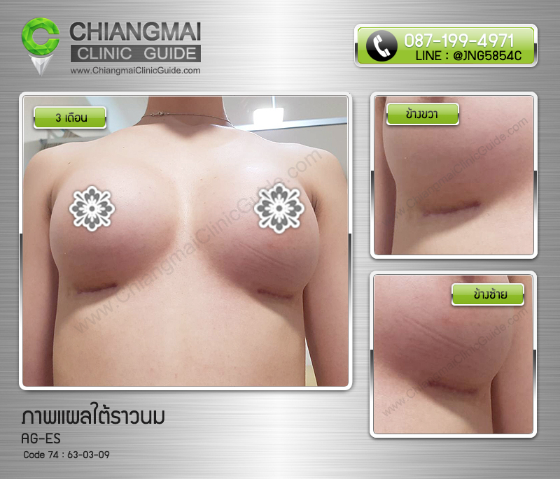 รีวิวเสริมหน้าอกเชียงใหม่ แผลใต้ราวนม