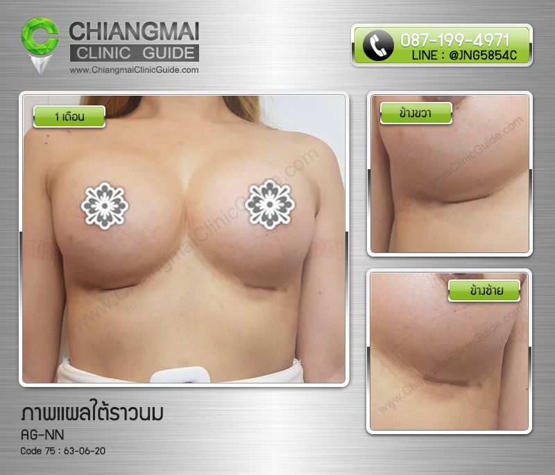 รีวิวเสริมหน้าอกเชียงใหม่ แผลใต้ราวนม