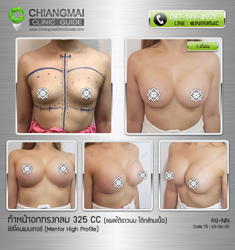รีวิวเสริมหน้าอกเชียงใหม่ ซิลิโคนเมนเทอร์ (Mentor) 325cc แผลใต้ราวนม วางซิลิโคนใต้กล้ามเนื้อ
