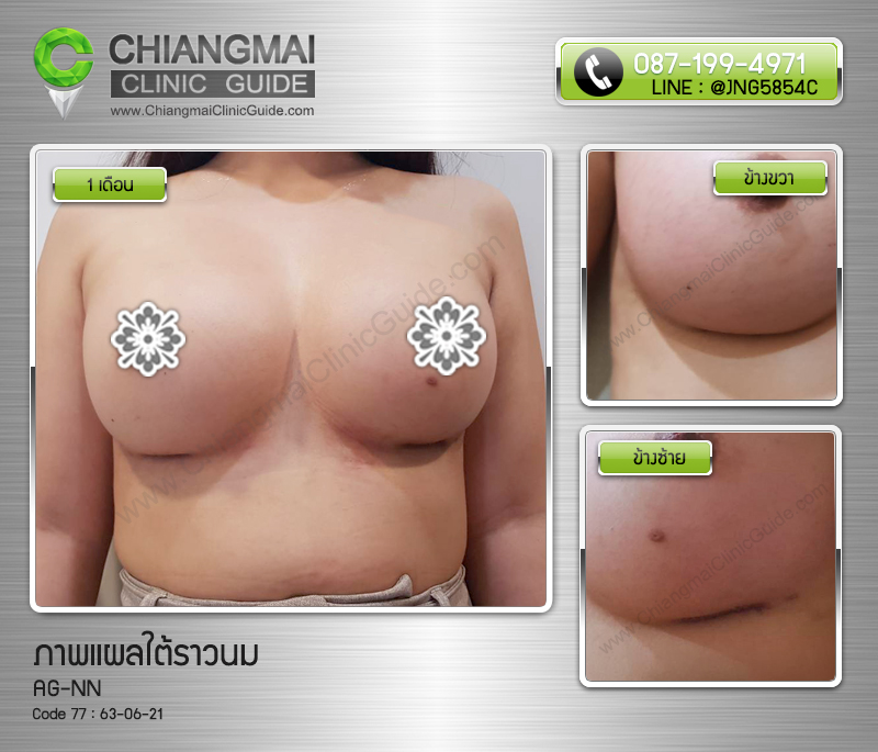 รีวิวเสริมหน้าอกเชียงใหม่ แผลใต้ราวนม