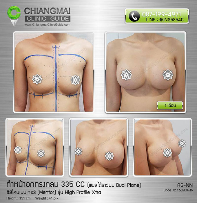 รีวิวเสริมหน้าอก ทำนม เชียงใหม่ ซิลิโคนเมนเทอร์ (Mentor) รุ่น Xtra High Profile 335cc แผลใต้ราวนม วางซิลิโคน Dual Plane