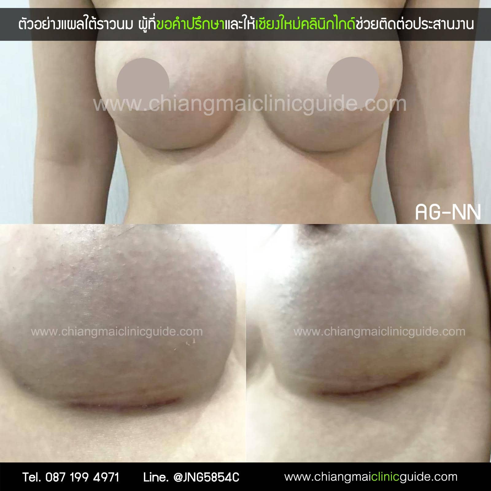 รีวิวเสริมหน้าอก ทำนม เชียงใหม่ แผลใต้ราวนม
