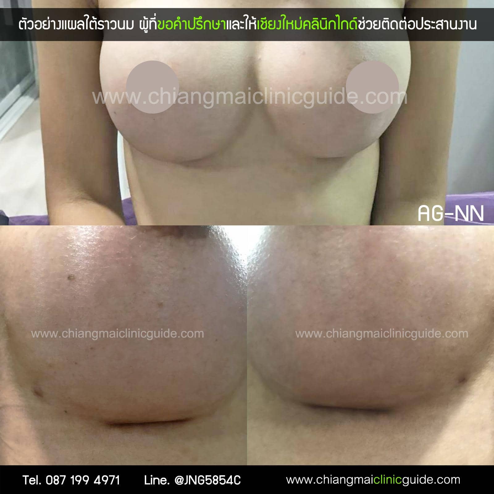 รีวิวเสริมหน้าอก ทำนม เชียงใหม่ แผลใต้ราวนม