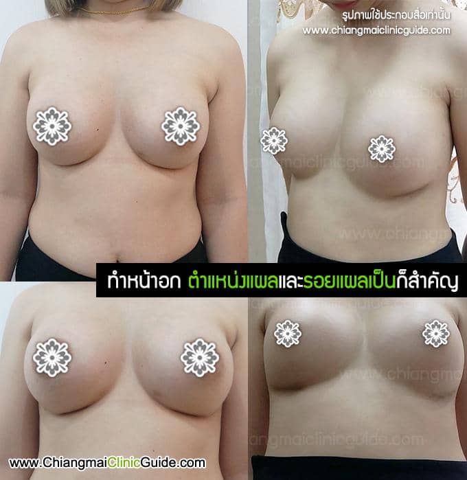 รีวิวเสริมหน้าอก ทำนม เชียงใหม่ แผลใต้ราวนม
