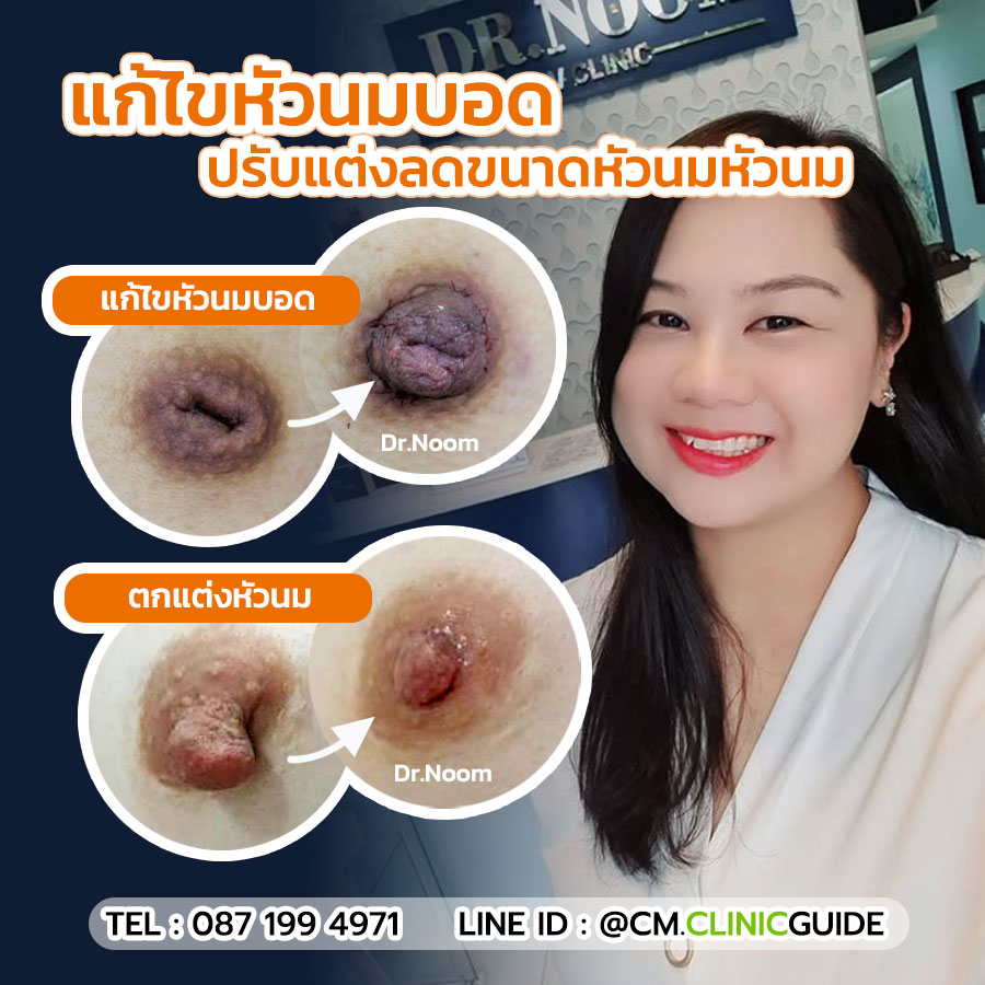 ศัลยกรรมทรวงอก เชียงใหม่ แก้ไขหัวนมบอด ตกแต่งปรับขนาดหัวนม