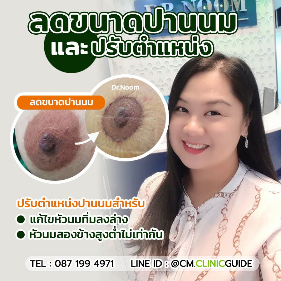 ลดขนาดปานนมและปรับตำแหน่งปานนมแก้หัวนมทิ่มลงล่าง หรือหัวนมสูงต่ำไม่เท่ากัน