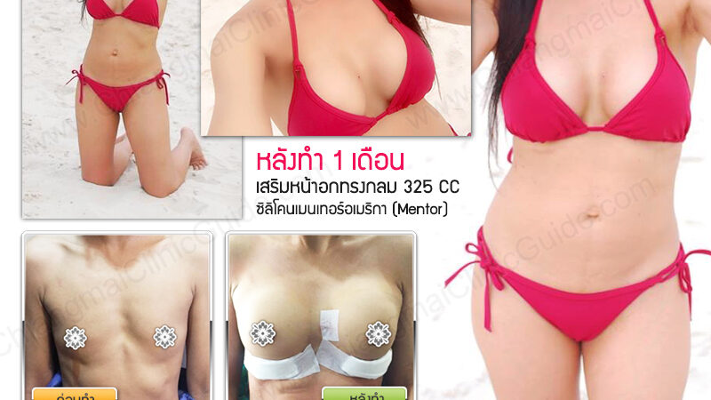 รีวิว เสริมหน้าอก เชียงใหม่ : ภาพตัวอย่างการแก้ไขทำนมเสริมอก