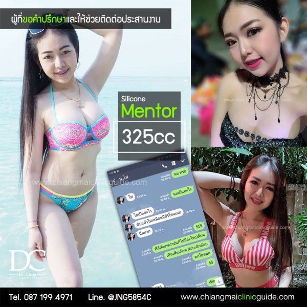 รีวิว เสริมหน้าอก ทำนม เสริมอก เชียงใหม่
