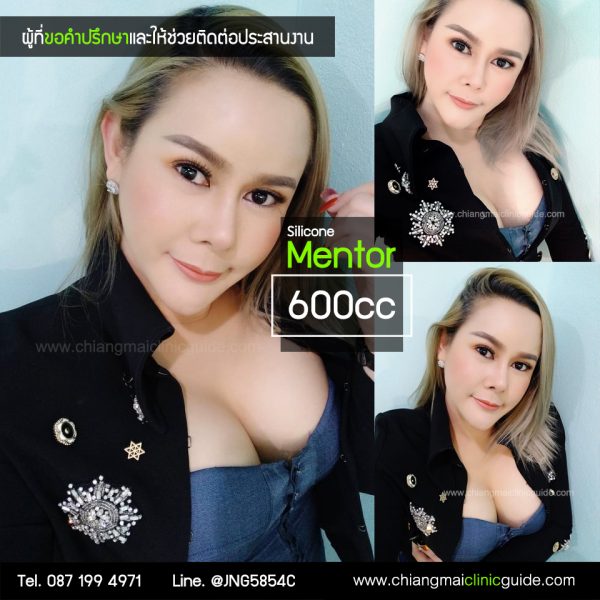 รีวิว เสริมหน้าอก ทำนม เสริมอก เชียงใหม่
